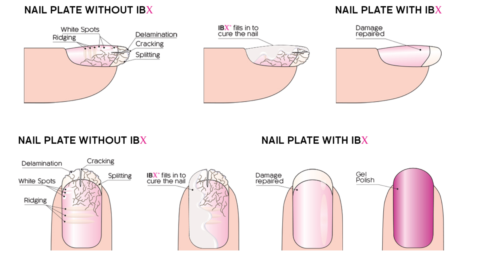 nail bed, nail plate, nail repair, delamination, peeling nails